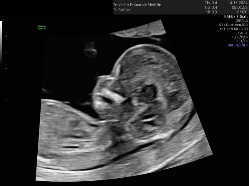 Ultraschall Ersttrimester Screening